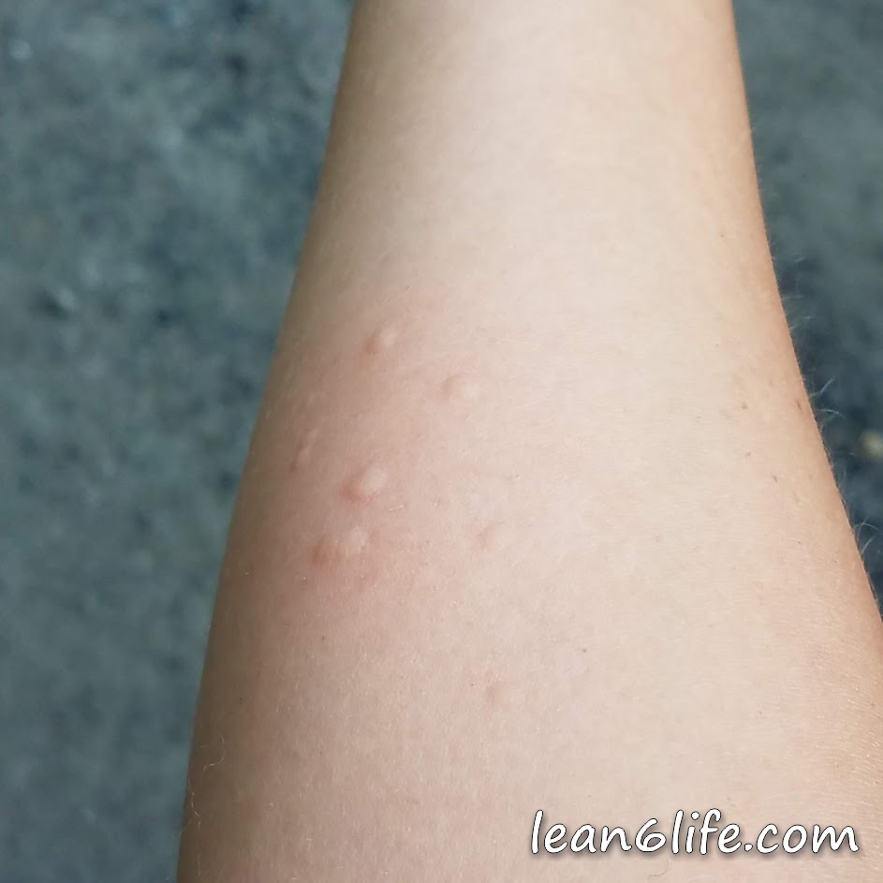 Battle wounds - me versus the nettle